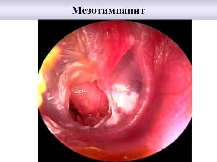Мезотимпанит 