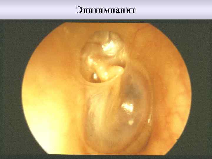 Эпитимпанит 