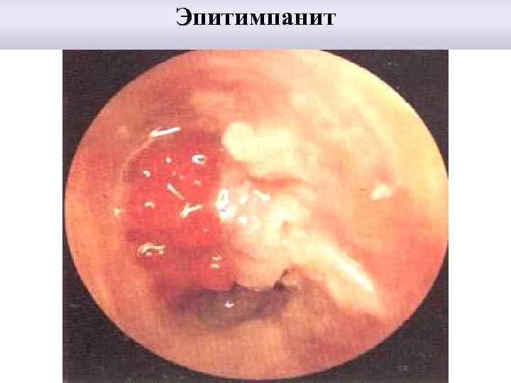 Эпитимпанит 