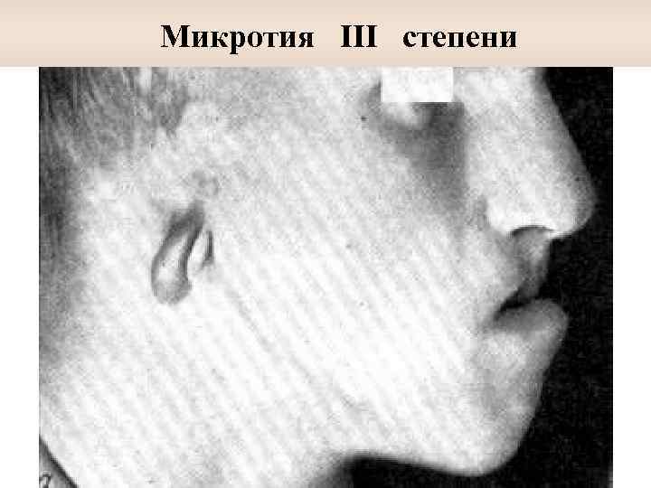  Микротия III степени 