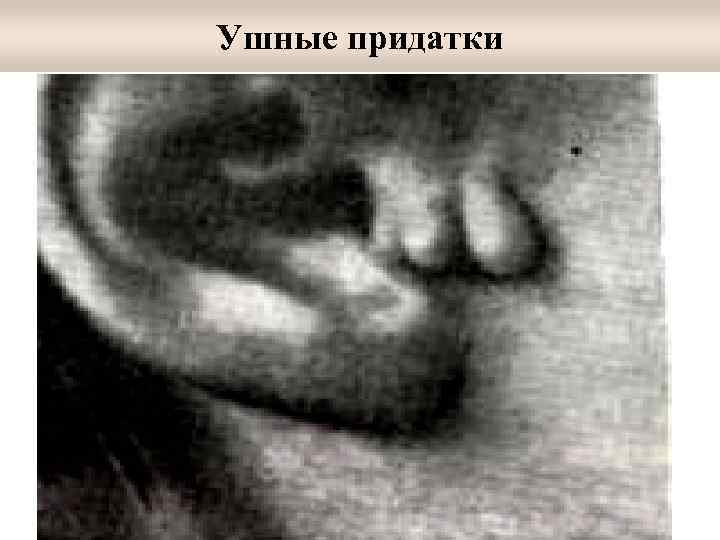 Ушные придатки 