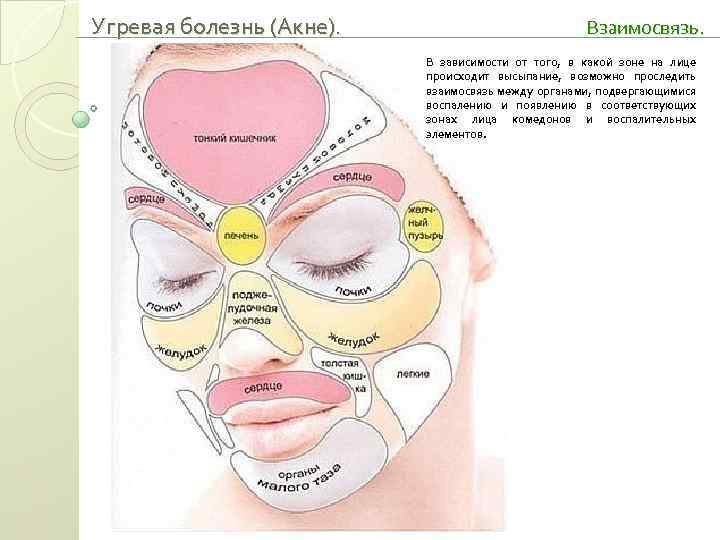 Угревая болезнь (Акне). Взаимосвязь. В зависимости от того, в какой зоне на лице происходит