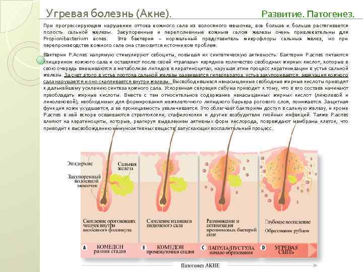 Патогенез акне схема