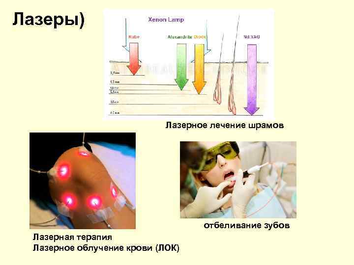 Лазеры) Лазерное лечение шрамов отбеливание зубов Лазерная терапия Лазерное облучение крови (ЛОК) 