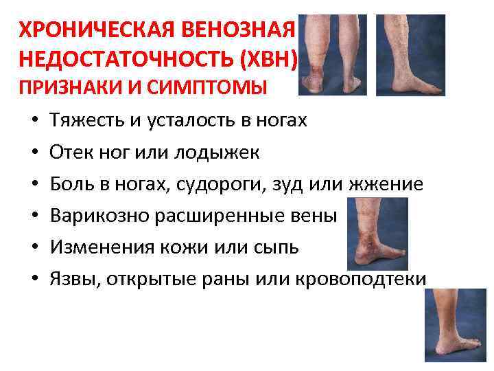 ХРОНИЧЕСКАЯ ВЕНОЗНАЯ НЕДОСТАТОЧНОСТЬ (ХВН) ПРИЗНАКИ И СИМПТОМЫ • Тяжесть и усталость в ногах •