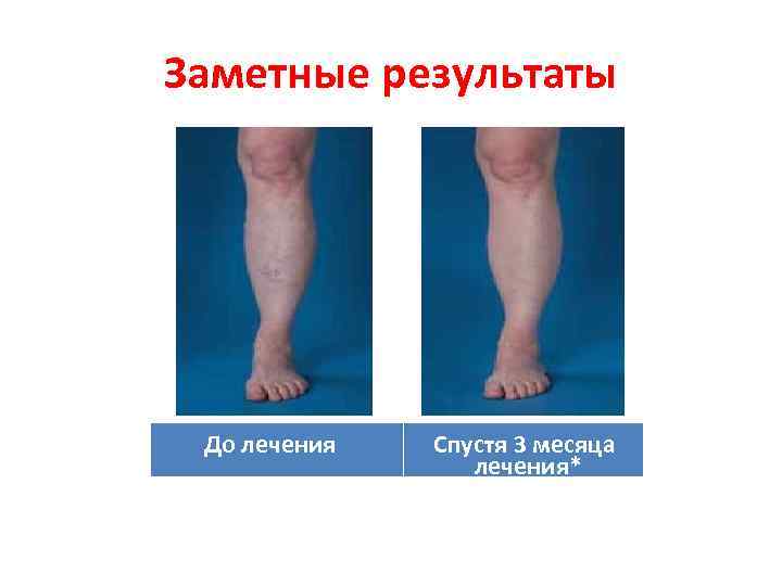 Заметные результаты До лечения Спустя 3 месяца лечения* 