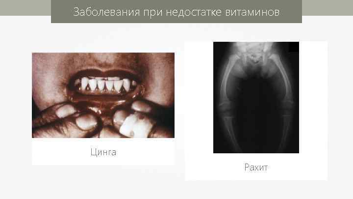 Заболевания при недостатке витаминов Цинга Рахит 