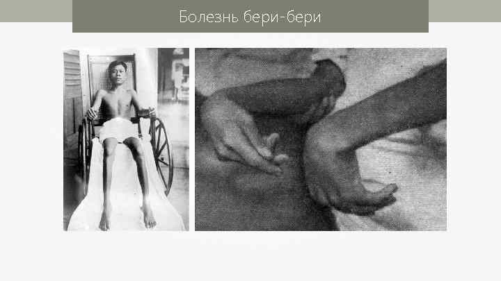 Болезнь бери-бери 