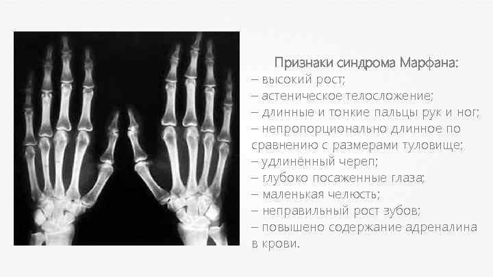 Признаки синдрома Марфана: – высокий рост; – астеническое телосложение; – длинные и тонкие пальцы