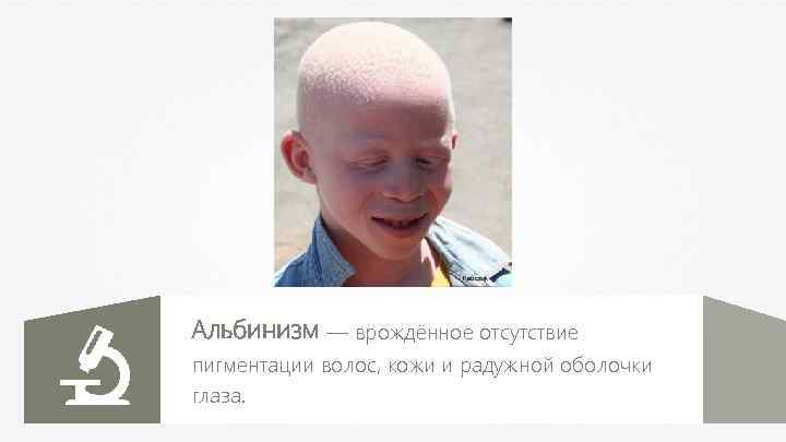 Kauczuk Альбинизм — врождённое отсутствие пигментации волос, кожи и радужной оболочки глаза. 