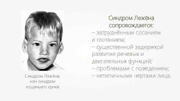 Синдром Лежёна, или синдром кошачьего крика Синдром Лежёна сопровождается: – затруднённым сосанием и глотанием;