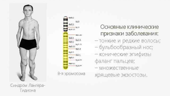 8 -я хромосома Синдром Лангера. Гидиона Основные клинические признаки заболевания: – тонкие и редкие