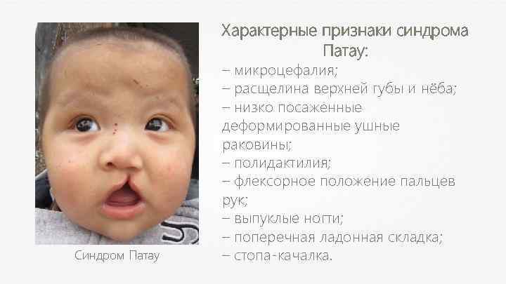 Характерные признаки синдрома Патау: Синдром Патау – микроцефалия; – расщелина верхней губы и нёба;