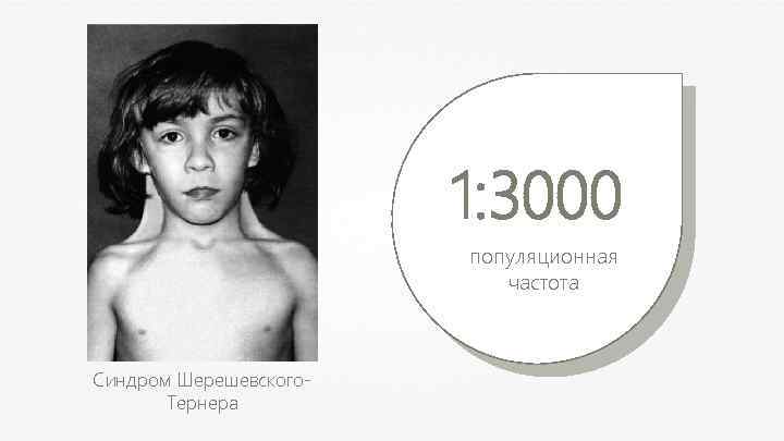 1: 3000 популяционная частота Синдром Шерешевского. Тернера 