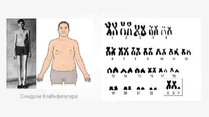 1: 1000 популяционная частота Синдром Клайнфельтера 