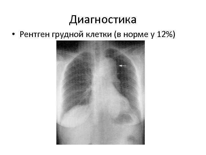 Диагностика • Рентген грудной клетки (в норме у 12%) 