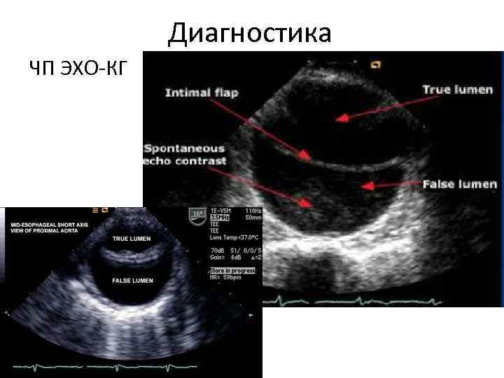 Диагностика ЧП ЭХО-КГ 