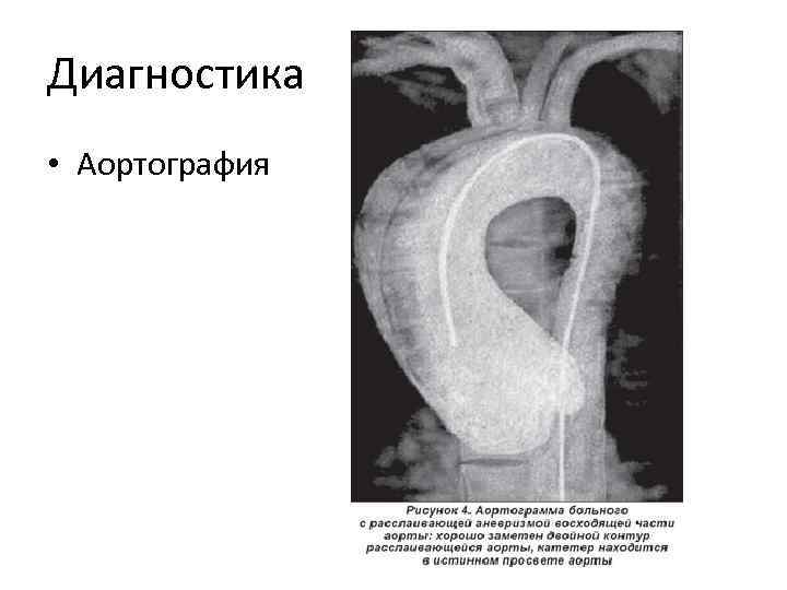 Расслаивающаяся аневризма аорты презентация