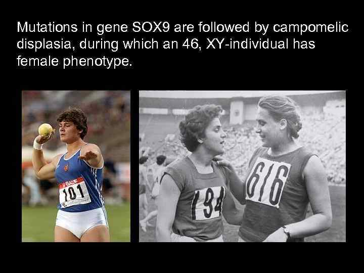 Mutations in gene SOX 9 are followed by campomelic displasia, during which an 46,