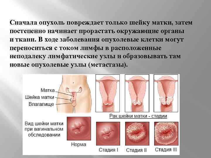 Сначала опухоль повреждает только шейку матки, затем постепенно начинает прорастать окружающие органы и ткани.