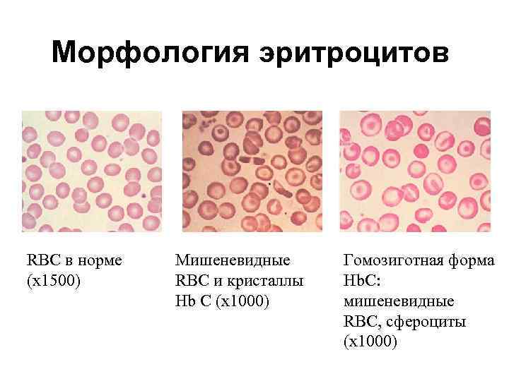 Морфологические изменения в эритроцитах рисунок