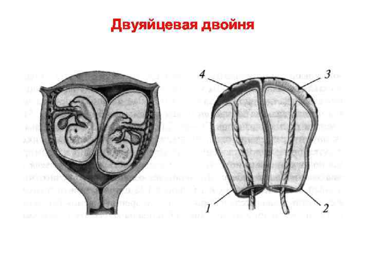 Двуяйцевая двойня 
