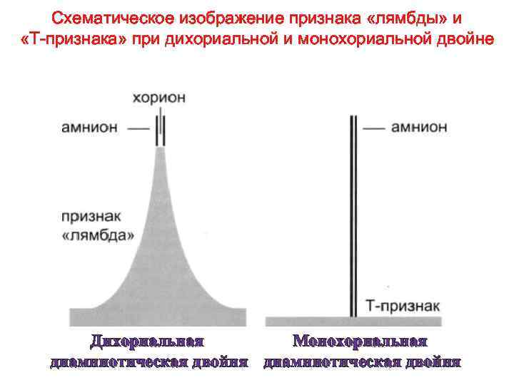 Схематическое изображение признака «лямбды» и «Т-признака» при дихориальной и монохориальной двойне Монохориальная Дихориальная диамниотическая