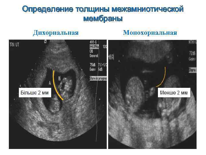Определение толщины межамниотической мембраны Дихориальная Монохориальная 