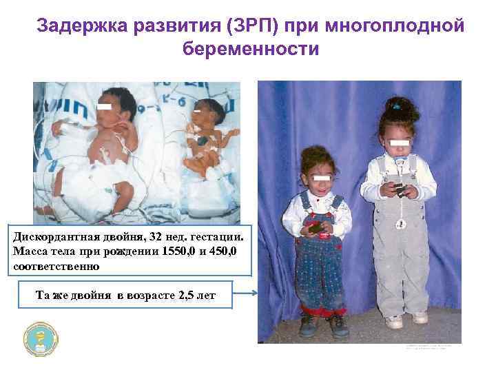Задержка развития (ЗРП) при многоплодной беременности Дискордантная двойня, 32 нед. гестации. Масса тела при
