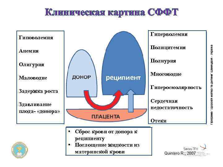 Клиническая картина СФФТ Гиперволемия Гиповолемия Полицитемия Анемия Полиурия Олигурия Маловодие реципиент Многоводие Гиперосмолярность Задержка