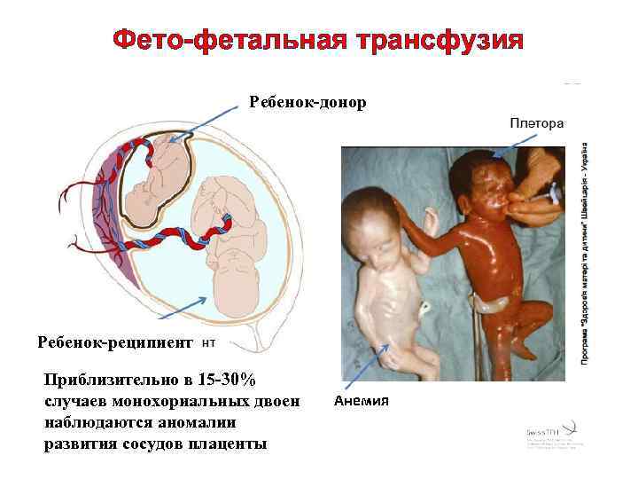 Фето-фетальная трансфузия Ребенок-донор Ребенок-реципиент Приблизительно в 15 -30% случаев монохориальных двоен наблюдаются аномалии развития