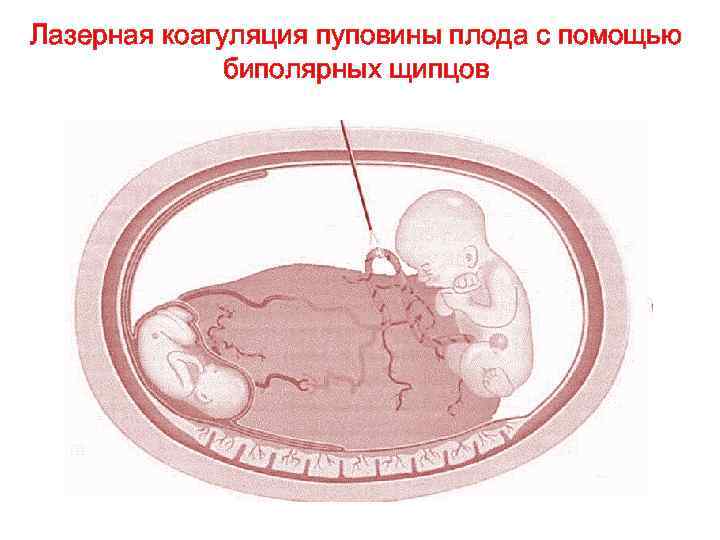 Лазерная коагуляция пуповины плода с помощью биполярных щипцов 