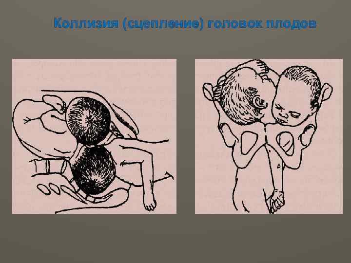 Коллизия (сцепление) головок плодов 