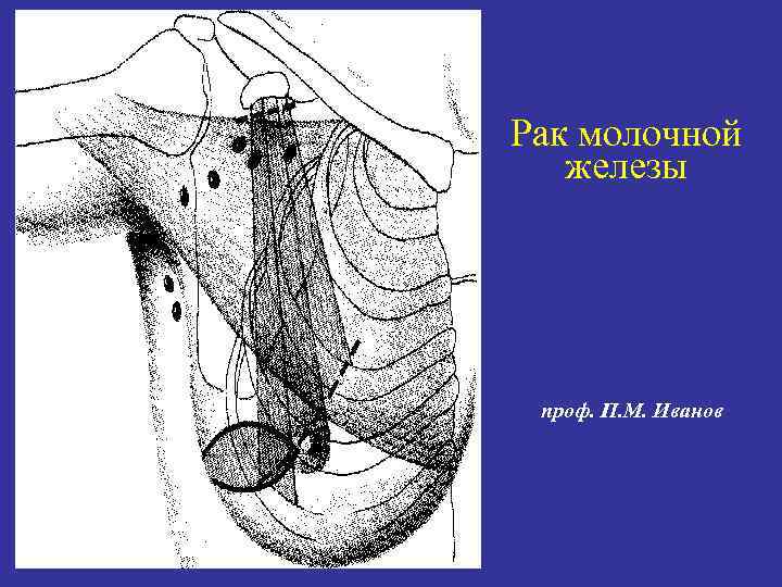 Рак молочной железы проф. П. М. Иванов 