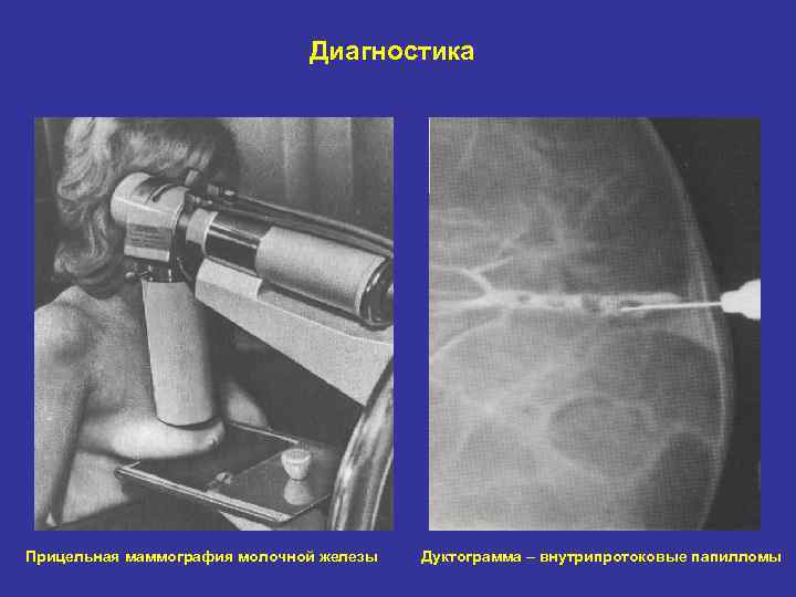 Диагностика Прицельная маммография молочной железы Дуктограмма – внутрипротоковые папилломы 