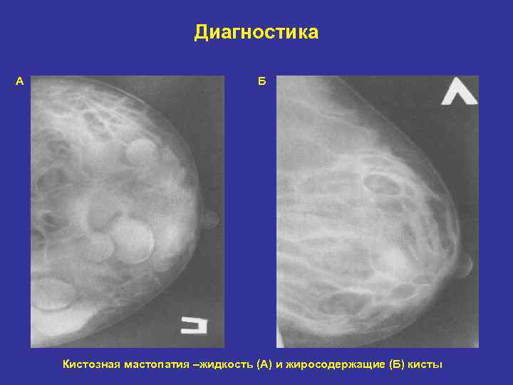 Диагностика А Б Кистозная мастопатия –жидкость (А) и жиросодержащие (Б) кисты 