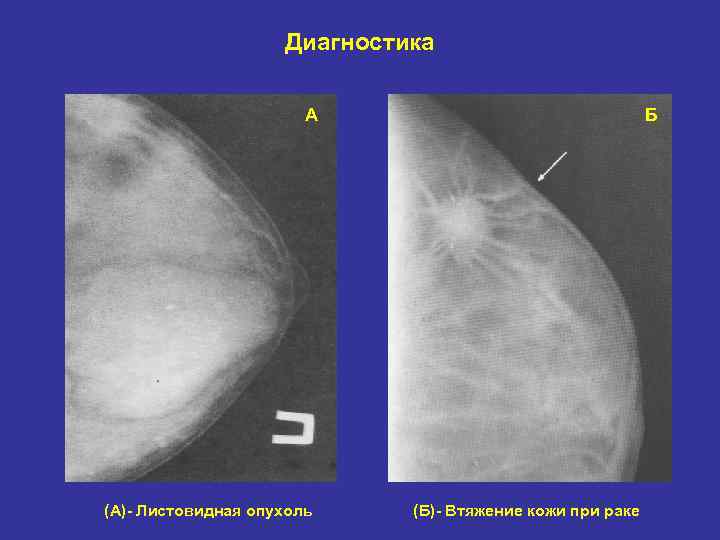 Диагностика А (А)- Листовидная опухоль Б (Б)- Втяжение кожи при раке 