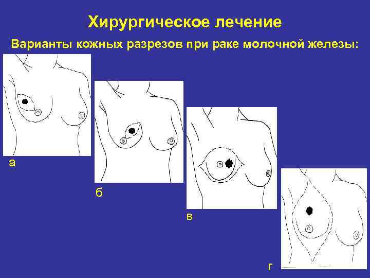 Хирургическое лечение Варианты кожных разрезов при раке молочной железы: г в б а а