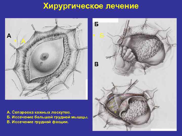 Хирургическое лечение Б А • Б В А. Сепаровка кожных лоскутов. Б. Иссечение большой