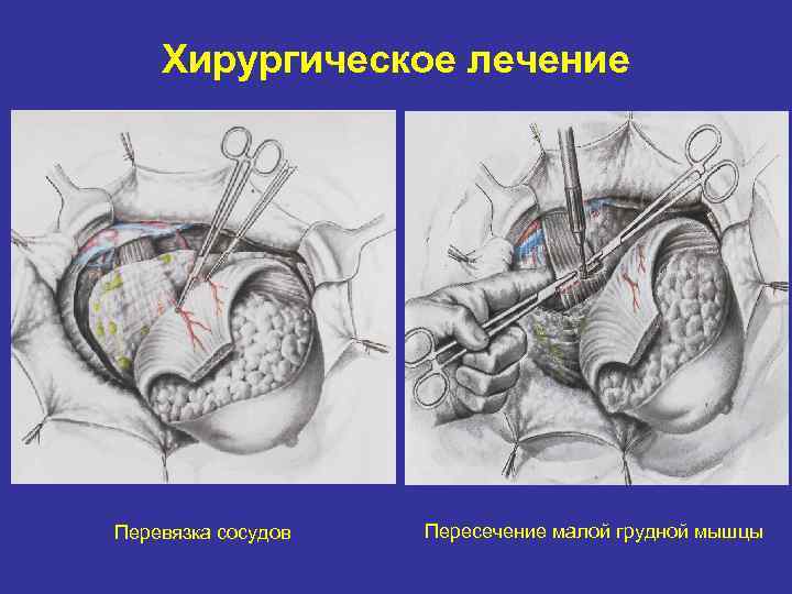 Хирургическое лечение Перевязка сосудов Пересечение малой грудной мышцы 