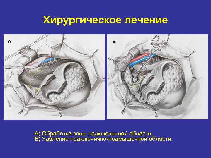 Хирургическое лечение А Б А) Обработка зоны подключичной области. Б) Удаление подключично подмышечной области.