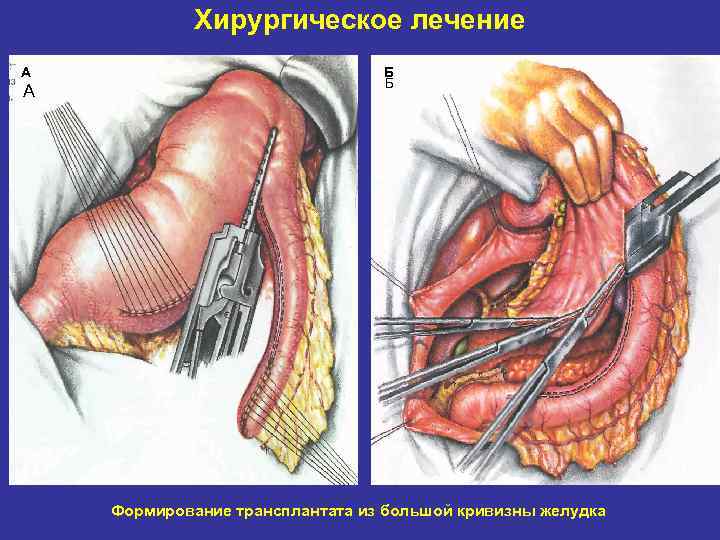 Хирургическое лечение А А Б Б Формирование трансплантата из большой кривизны желудка 