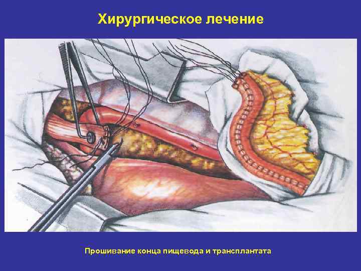Хирургическое лечение Прошивание конца пищевода и трансплантата 