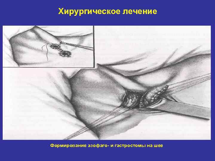 Хирургическое лечение Формирование эзофаго- и гастростомы на шее 