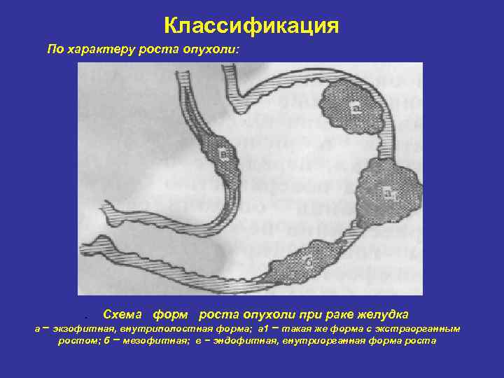 Классификация По характеру роста опухоли: . Схема форм роста опухоли при раке желудка а