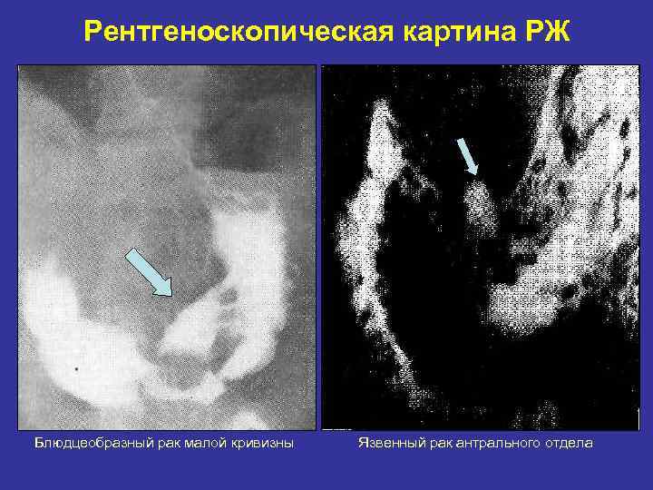 Рентгеноскопическая картина РЖ Блюдцеобразный рак малой кривизны Язвенный рак антрального отдела 