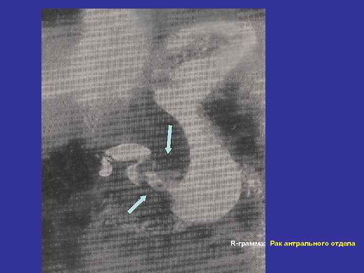 R-грамма: Рак антрального отдела 