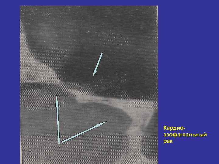 Кардиоэзофагеальный рак 