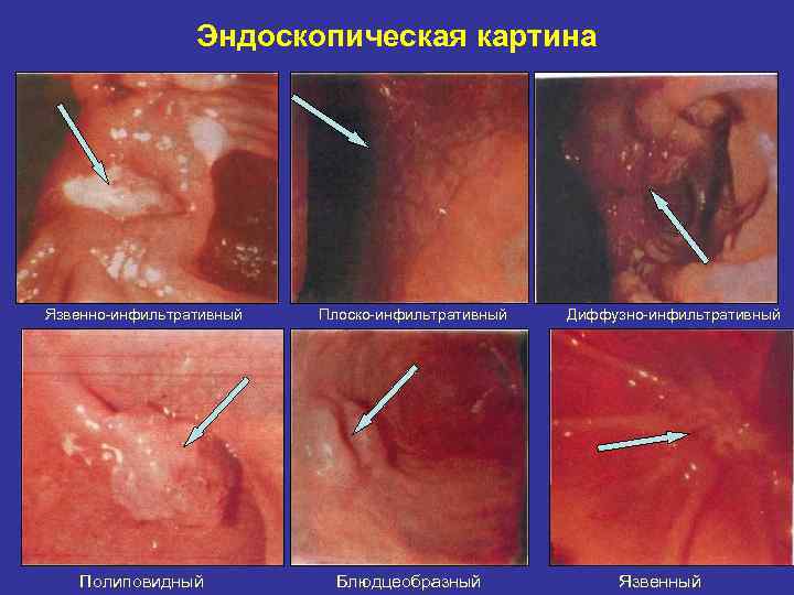Эндоскопическая картина Язвенно-инфильтративный Плоско-инфильтративный Полиповидный Блюдцеобразный Диффузно-инфильтративный Язвенный 