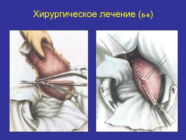 Хирургическое лечение (Б-II) 
